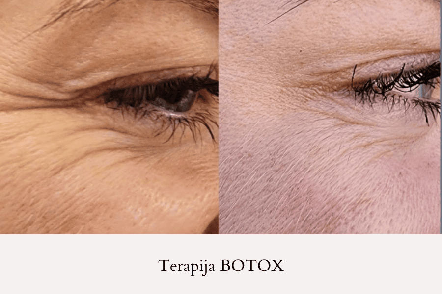 Botox: Glajenje gubic okoli oči
