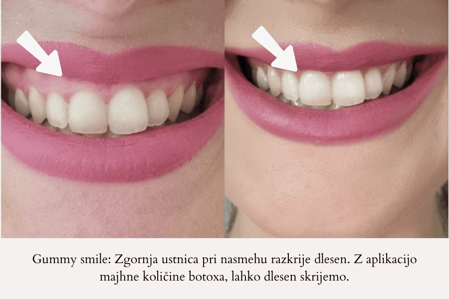 Skritje dlesni ob nasmehu z aplikacijo botoxa