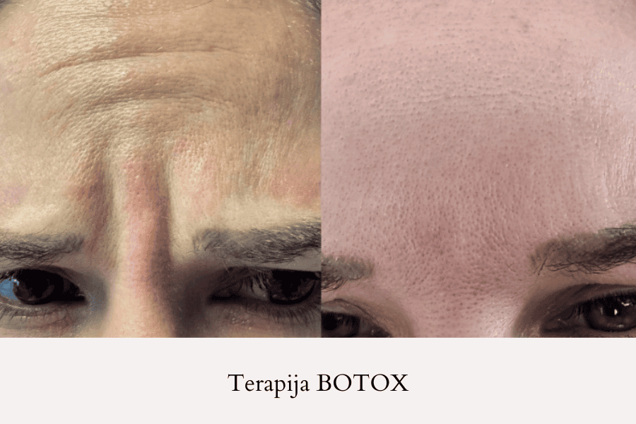Botox: Glajenje gubic na čelu