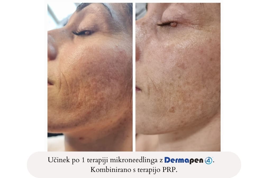 Učinek po eni terapiji microneedling z Dermapen 4.