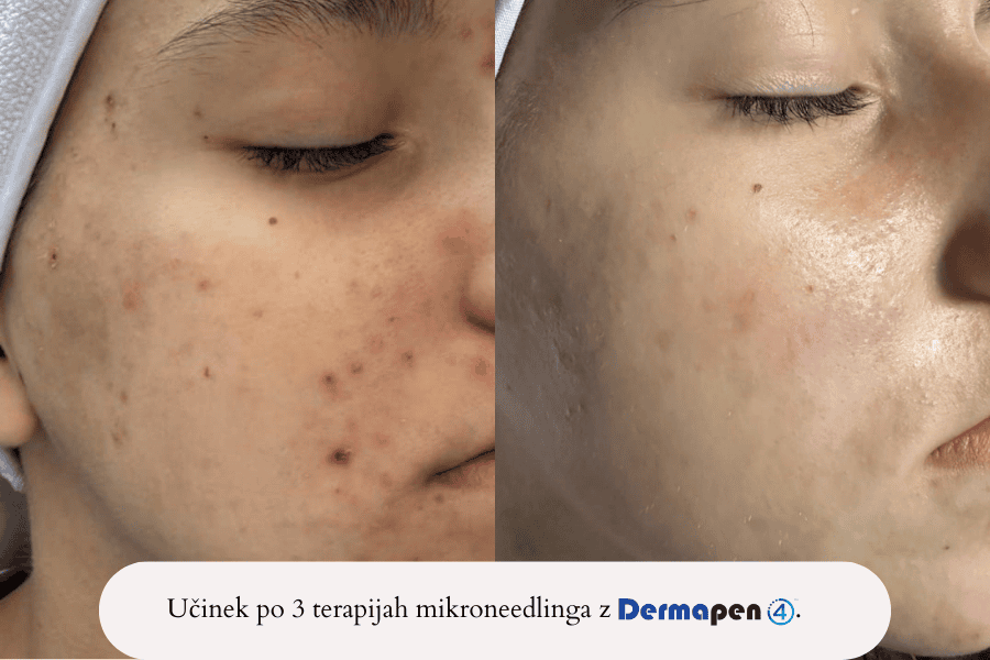 Učinek po treh terapijah microneedlinga.